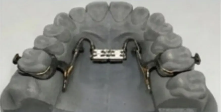Rapid palatal expander on 3D printed model