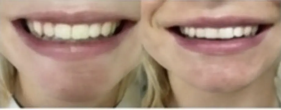 Smile before and after restorative case