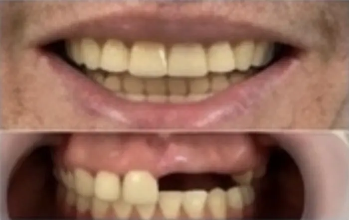 Restorative case with missing tooth replaced